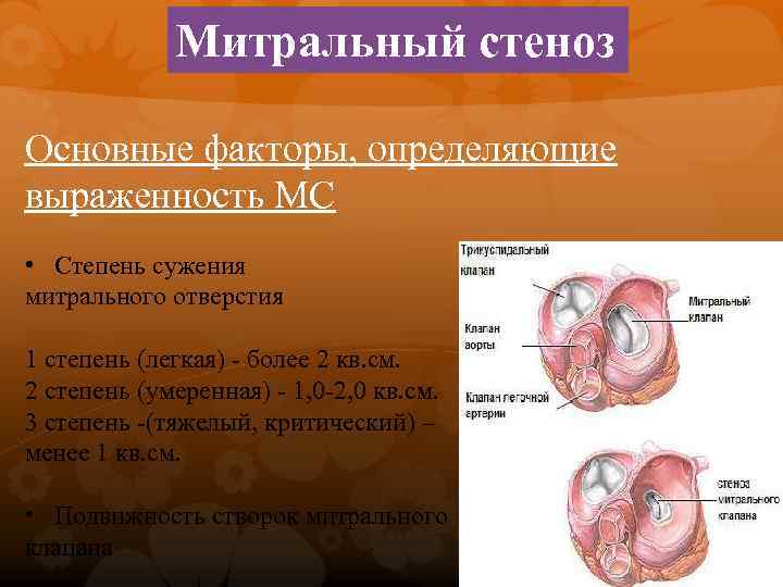 Митральный стеноз Основные факторы, определяющие выраженность МС • Степень сужения митрального отверстия 1 степень