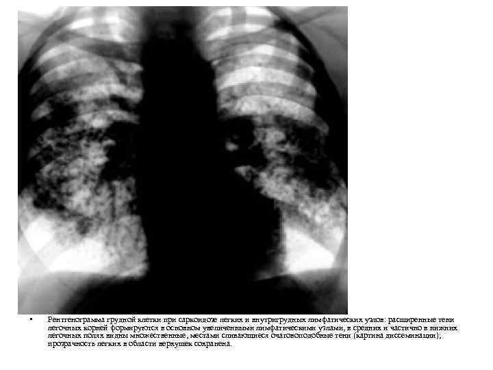  • Рентгенограмма грудной клетки при саркоидозе легких и внутригрудных лимфатических узлов: расширенные тени