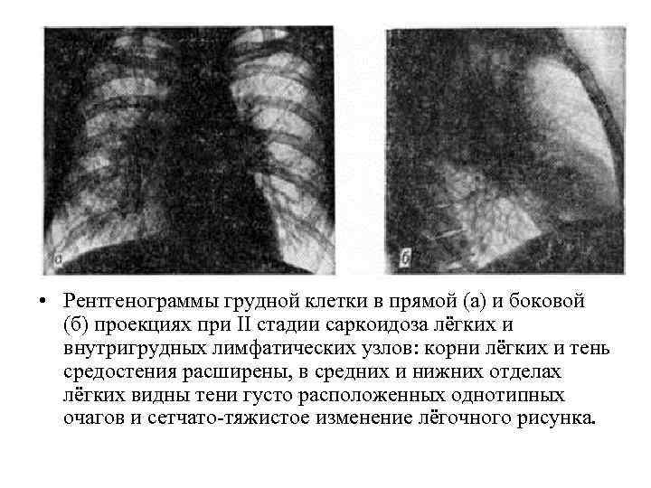 Лимфаденопатия корня. Саркоидоз внутригрудных лимфоузлов рентген. Саркоидоз внутригрудных лимфатических узлов рентген. Лимфаденопатия внутригрудных лимфоузлов рентген. Саркоидоз легких 2 стадия рентген.