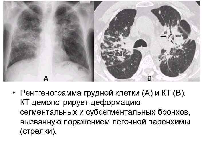  • Рентгенограмма грудной клетки (A) и КТ (B). КТ демонстрирует деформацию сегментальных и