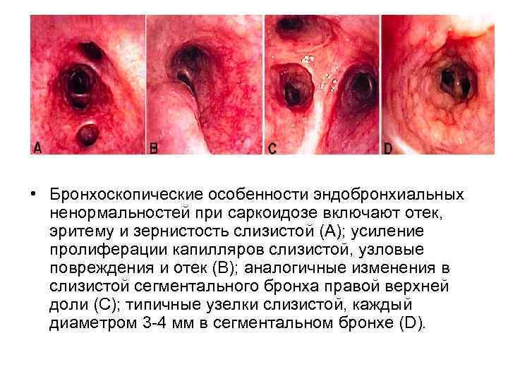  • Бронхоскопические особенности эндобронхиальных ненормальностей при саркоидозе включают отек, эритему и зернистость слизистой