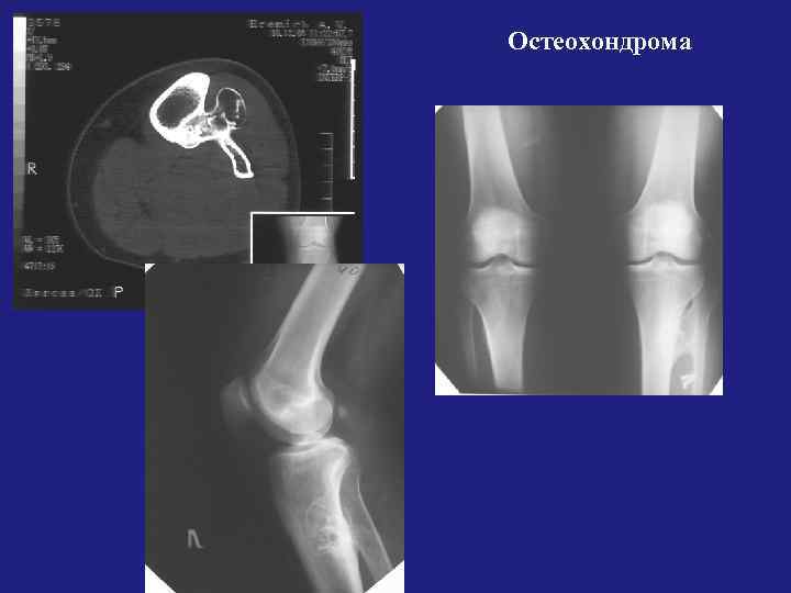 Остеохондрома бедренной. Остеохондрома бедренной кости кт. Остеохондрома плечевой кости на кт. Остеохондрома лопатки рентген. Остеохондрома лучевой кости.