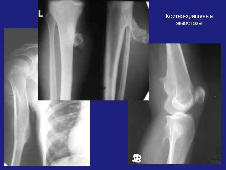 Экзостоз кости. Экзостоз лучевой кости. Экзостоз большеберцовой кости рентген. Экзостоз бедренной кости на рентгене. Костно хрящевой экзостоз бедренной кости на кт.