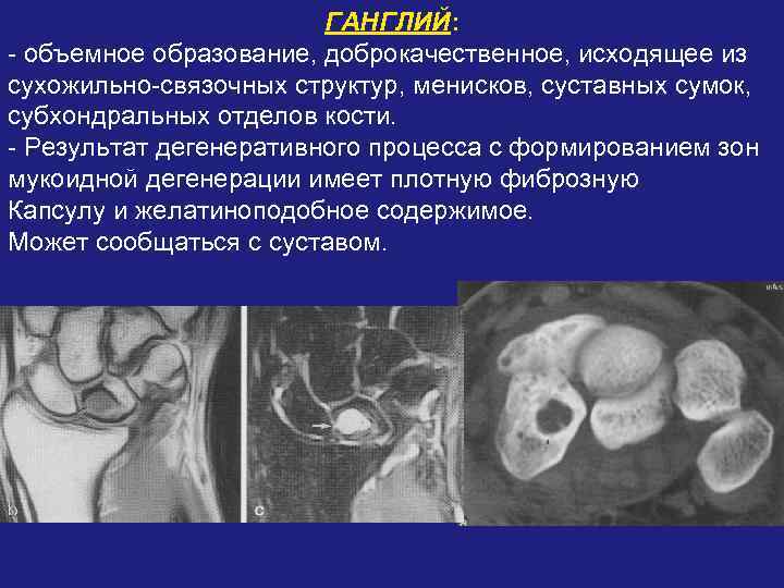 ГАНГЛИЙ: - объемное образование, доброкачественное, исходящее из сухожильно-связочных структур, менисков, суставных сумок, субхондральных отделов