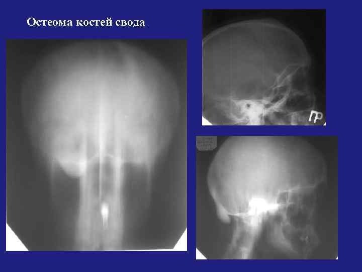 Остеома. Остеома затылочной кости рентген. Остеома коленного сустава рентген. Интракраниальная остеома.