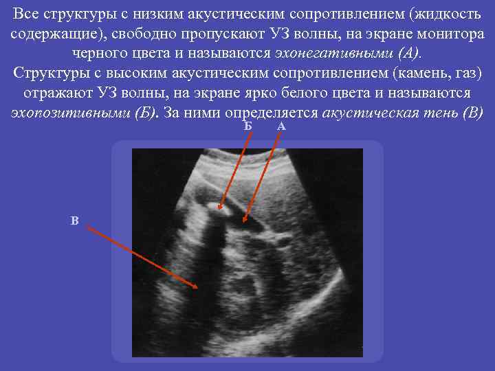 Все структуры с низким акустическим сопротивлением (жидкость содержащие), свободно пропускают УЗ волны, на экране