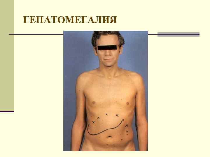 ГЕПАТОМЕГАЛИЯ 