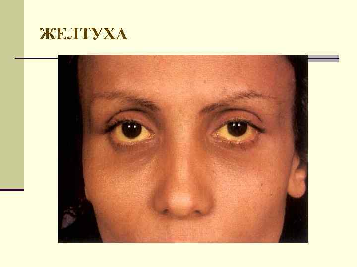ЖЕЛТУХА 