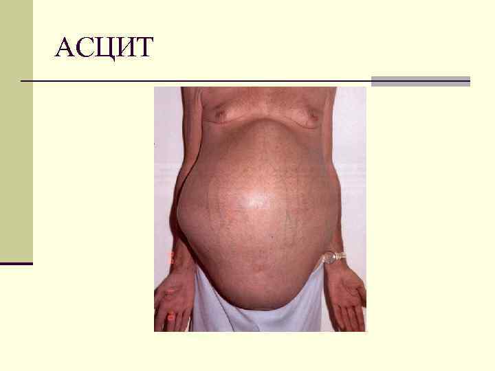 АСЦИТ 