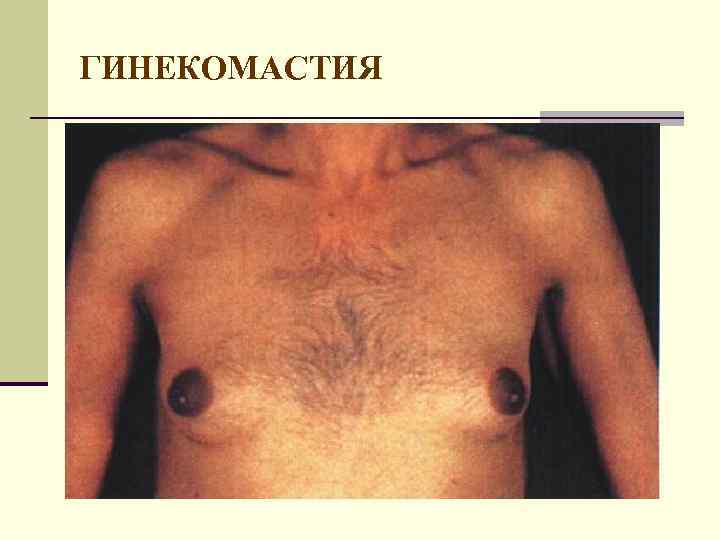 ГИНЕКОМАСТИЯ 