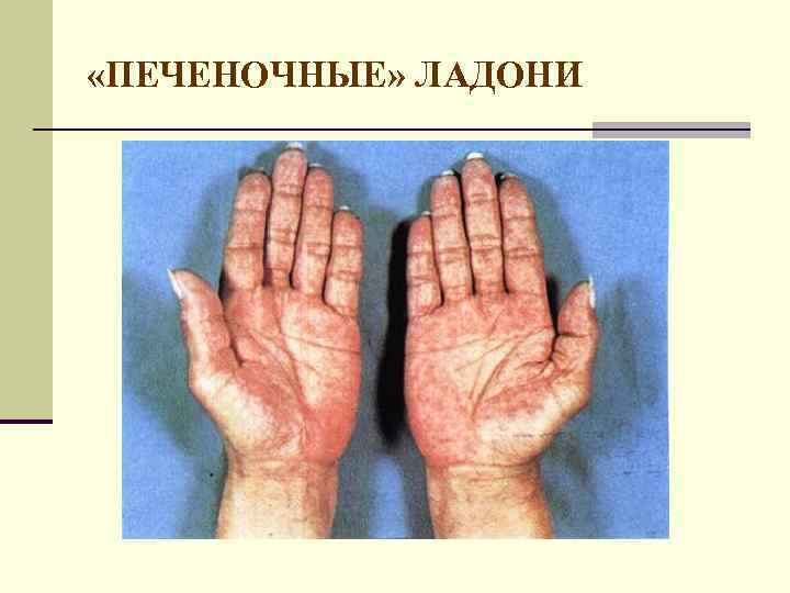  «ПЕЧЕНОЧНЫЕ» ЛАДОНИ 