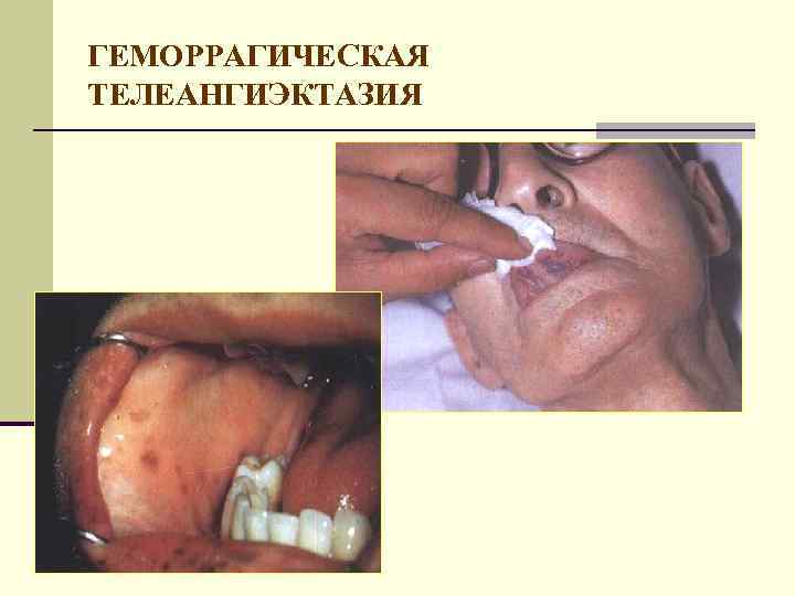 ГЕМОРРАГИЧЕСКАЯ ТЕЛЕАНГИЭКТАЗИЯ 