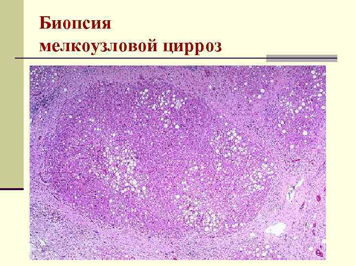 Биопсия мелкоузловой цирроз 