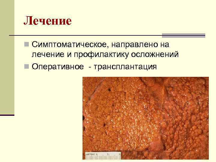 Лечение n Симптоматическое, направлено на лечение и профилактику осложнений n Оперативное - трансплантация 