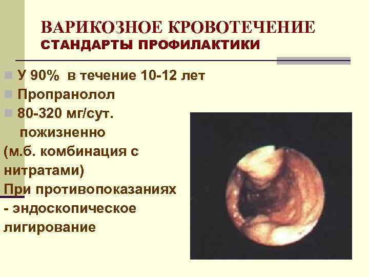 ВАРИКОЗНОЕ КРОВОТЕЧЕНИЕ СТАНДАРТЫ ПРОФИЛАКТИКИ n У 90% в течение 10 -12 лет n Пропранолол