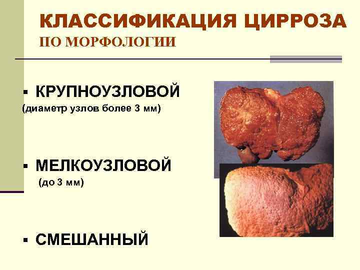 КЛАССИФИКАЦИЯ ЦИРРОЗА ПО МОРФОЛОГИИ § КРУПНОУЗЛОВОЙ (диаметр узлов более 3 мм) § МЕЛКОУЗЛОВОЙ (до