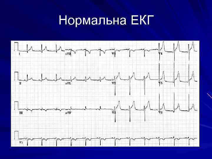 Нормальна ЕКГ 