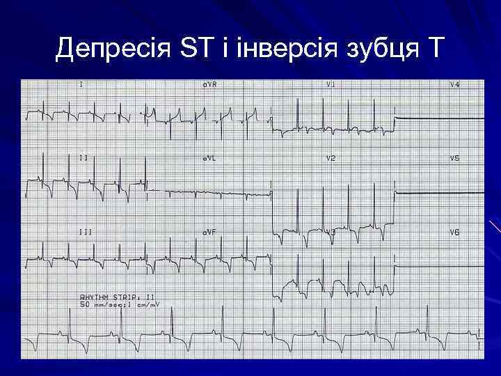 Депресія ST і інверсія зубця T 