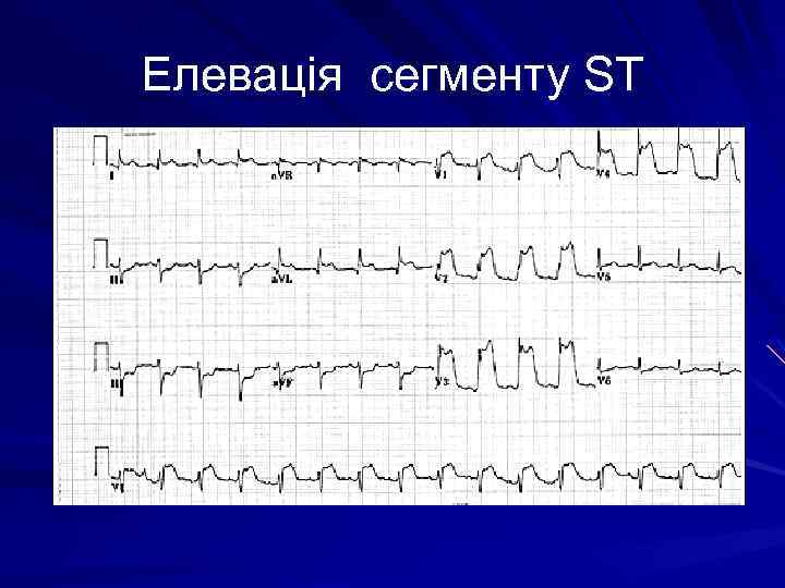 Елевація сегменту ST 