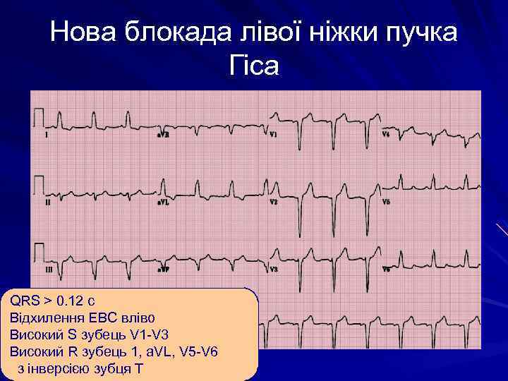 Нова блокада лівої ніжки пучка Гіса QRS > 0. 12 с Відхилення ЕВС вліво