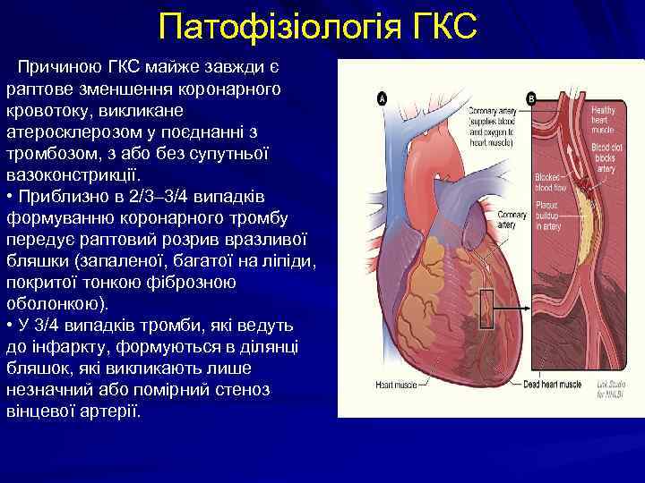 Патофізіологія ГКС Причиною ГКС майже завжди є раптове зменшення коронарного кровотоку, викликане атеросклерозом у
