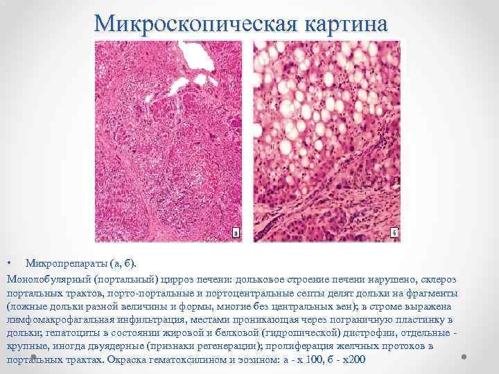 Микроскопическая картина • Микропрепараты (а, б). Монолобулярный (портальный) цирроз печени: дольковое строение печени нарушено,