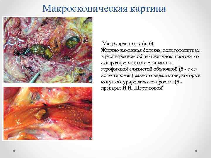 Макроскопическая картина Макропрепараты (а, б). Желчно-каменная болезнь, холедохолитиаз: в расширенном общем желчном протоке со