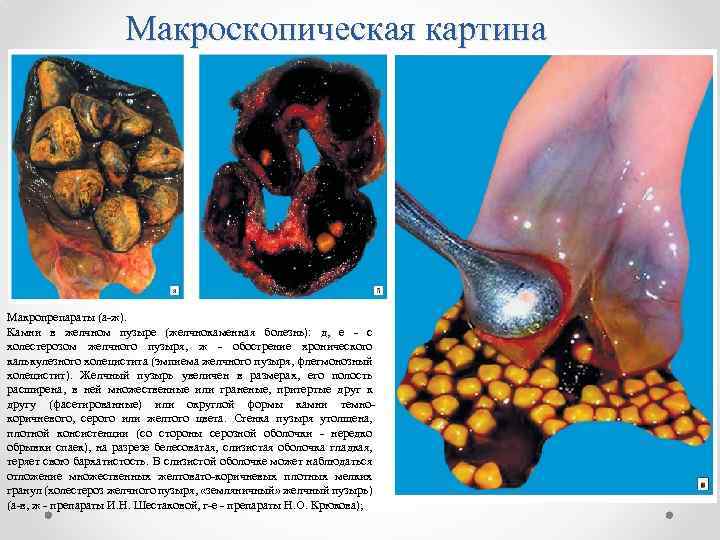 Макроскопическая картина Макропрепараты (а-ж). Камни в желчном пузыре (желчнокаменная болезнь): д, е - с