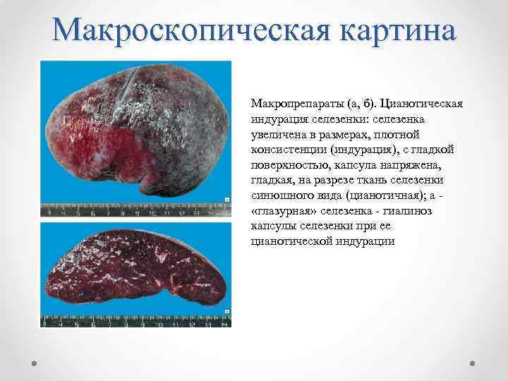 Макроскопическая картина Макропрепараты (а, б). Цианотическая индурация селезенки: селезенка увеличена в размерах, плотной консистенции