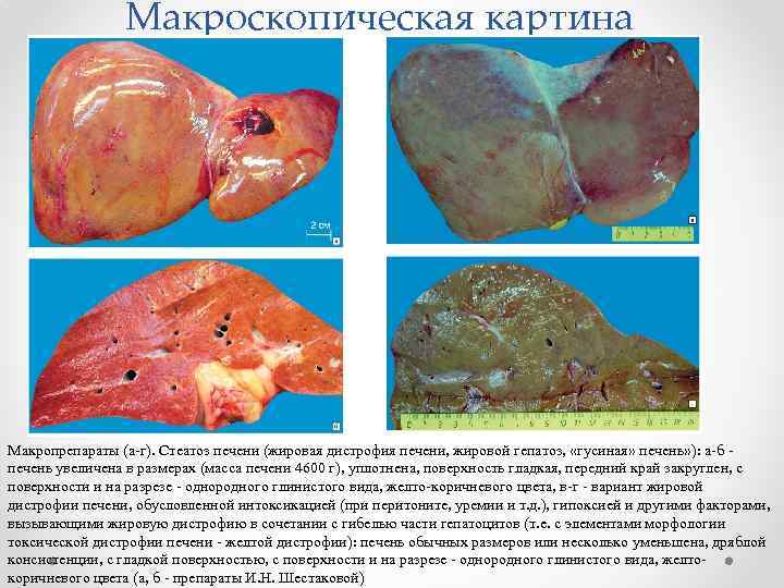 Макроскопическая картина Макропрепараты (а-г). Стеатоз печени (жировая дистрофия печени, жировой гепатоз, «гусиная» печень» ):