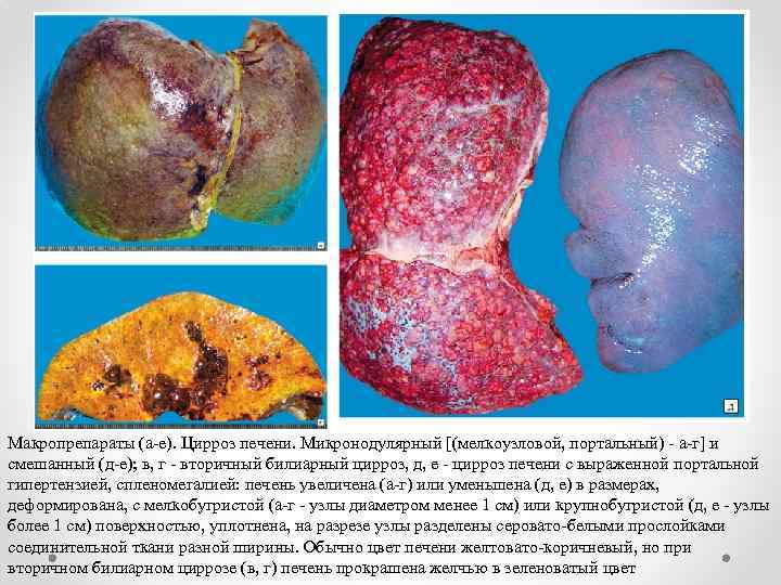 Макропрепараты (а-е). Цирроз печени. Микронодулярный [(мелкоузловой, портальный) - а-г] и смешанный (д-е); в, г