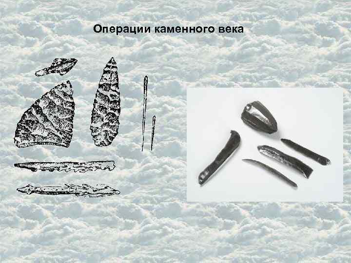 Операции каменного века 
