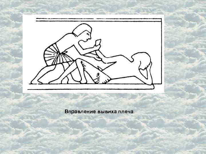 Вправление вывиха плеча 