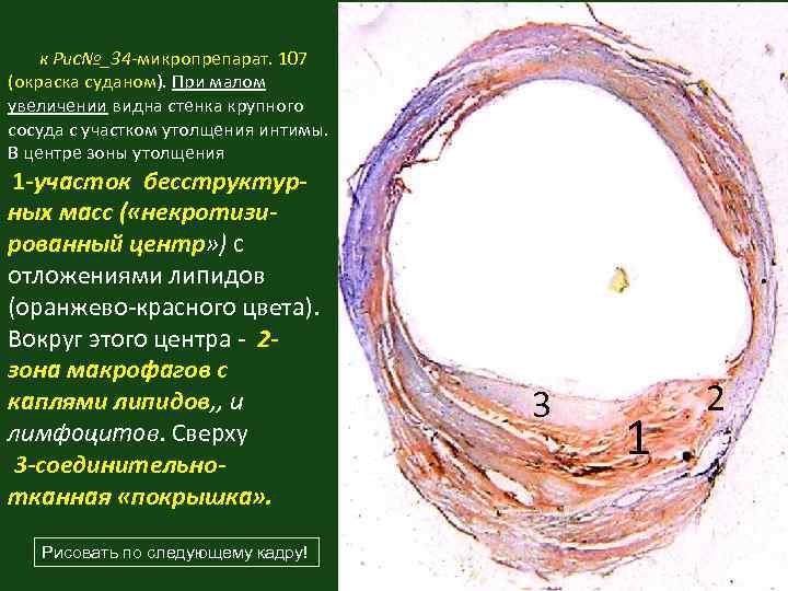 Атеросклероз аорты и коронарных артерий