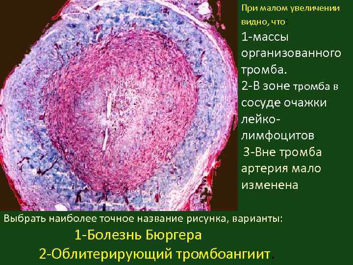 При малом увеличении видно, что: 1 -массы организованного тромба. 2 -В зоне тромба в