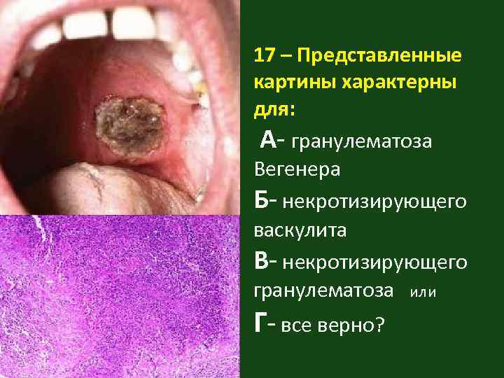 17 – Представленные картины характерны для: А- гранулематоза Вегенера Б- некротизирующего васкулита В- некротизирующего