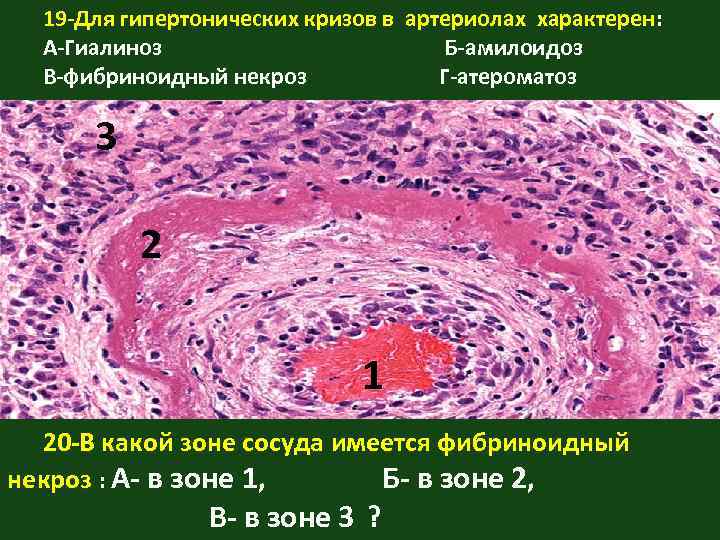 Гиалиноз относится к