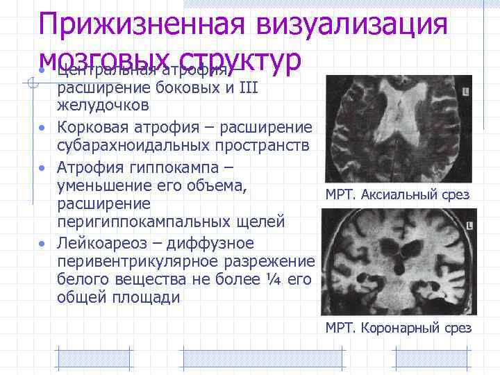 Прижизненная визуализация мозговых структур • Центральная атрофия – расширение боковых и III желудочков •