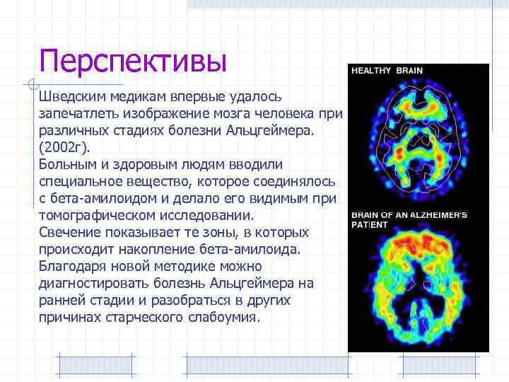 Перспективы Шведским медикам впервые удалось запечатлеть изображение мозга человека при различных стадиях болезни Альцгеймера.