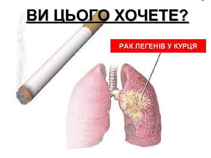 ВИ ЦЬОГО ХОЧЕТЕ? РАК ЛЕГЕНІВ У КУРЦЯ 