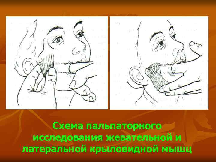 Схема пальпаторного исследования жевательной и латеральной крыловидной мышц 