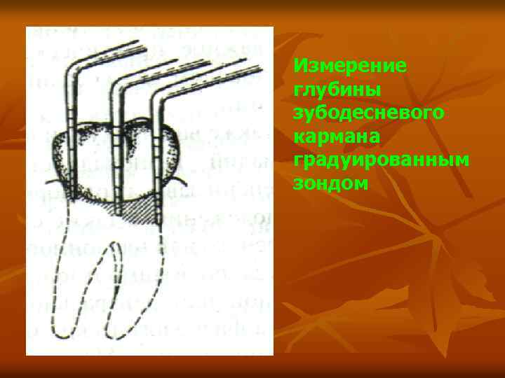 Измерение глубины зубодесневого кармана градуированным зондом 