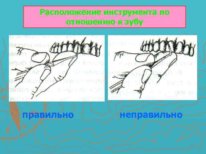 Расположение инструмента по отношению к зубу правильно неправильно 