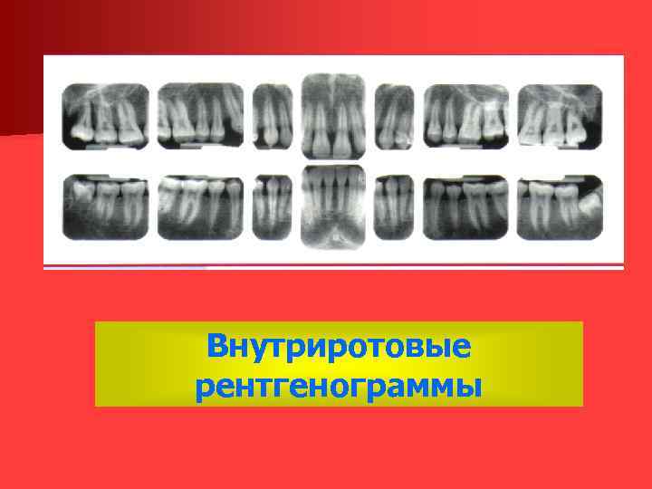 Внутриротовые рентгенограммы 