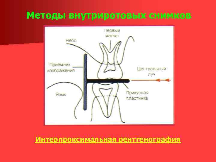 Методы внутриротовых снимков Интерпроксимальная рентгенография 