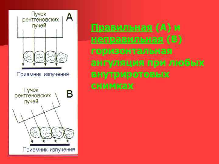 Правильная (А) и неправильная (В) горизонтальная ангуляция при любых внутриротовых снимках 