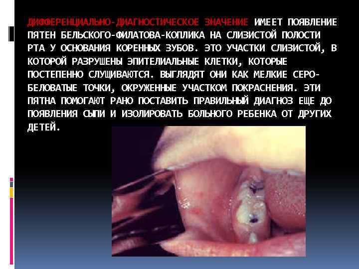 ДИФФЕРЕНЦИАЛЬНО-ДИАГНОСТИЧЕСКОЕ ЗНАЧЕНИЕ ИМЕЕТ ПОЯВЛЕНИЕ ПЯТЕН БЕЛЬСКОГО-ФИЛАТОВА-КОПЛИКА НА СЛИЗИСТОЙ ПОЛОСТИ РТА У ОСНОВАНИЯ КОРЕННЫХ ЗУБОВ.