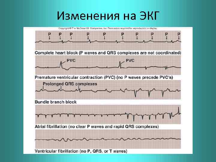 Изменения на ЭКГ 