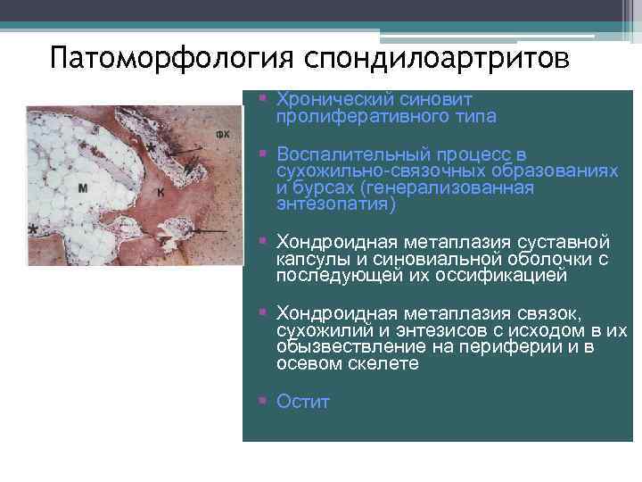 Патоморфология спондилоартритов Хронический синовит пролиферативного типа Воспалительный процесс в сухожильно-связочных образованиях и бурсах (генерализованная