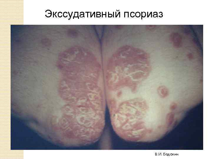 Экссудативный псориаз В. И. Бадокин 